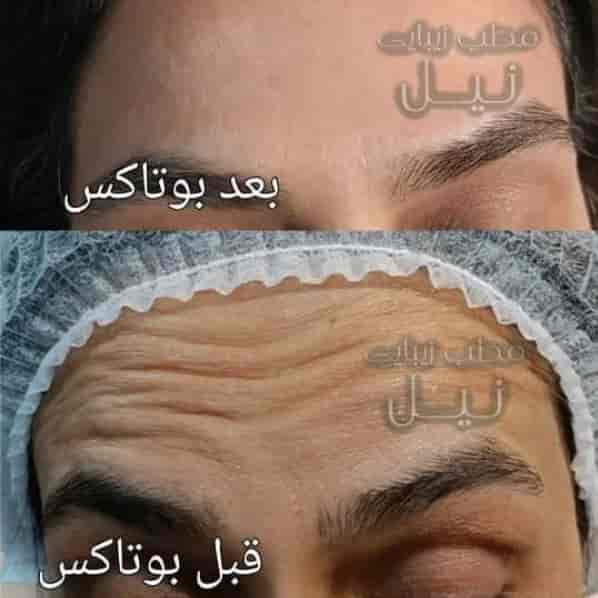 Botoks