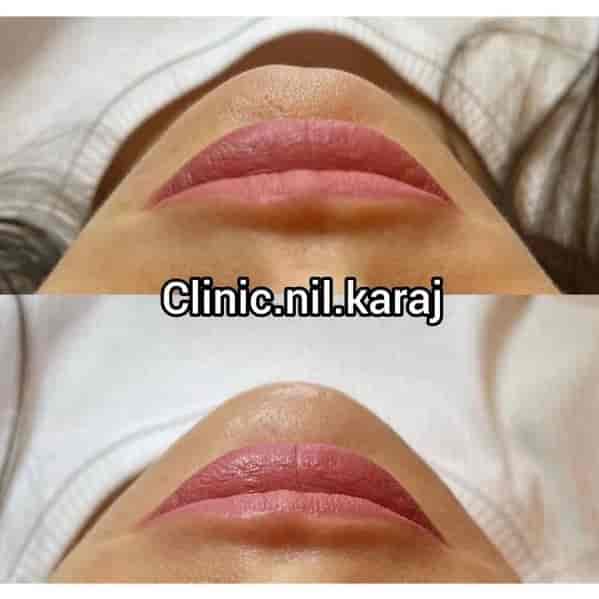 Dolgu çenesi