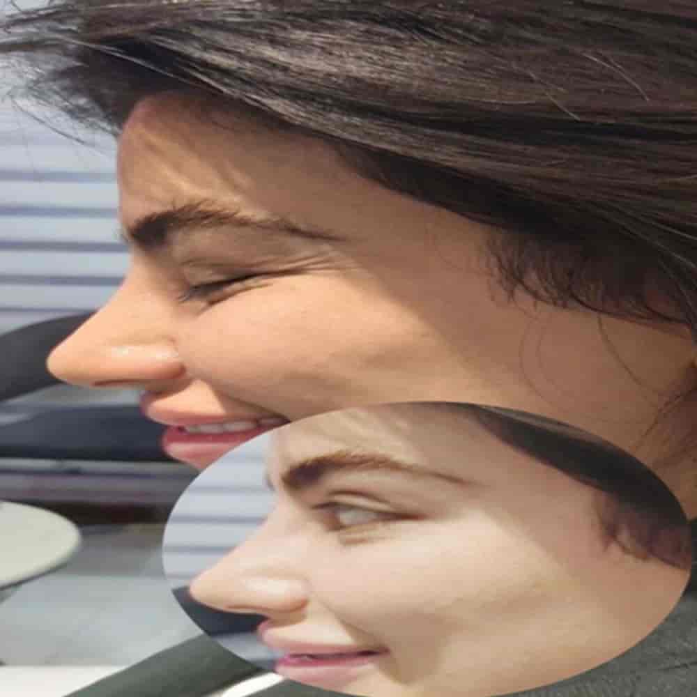 Güzel kaz ayaklarını gidermek için Botoks